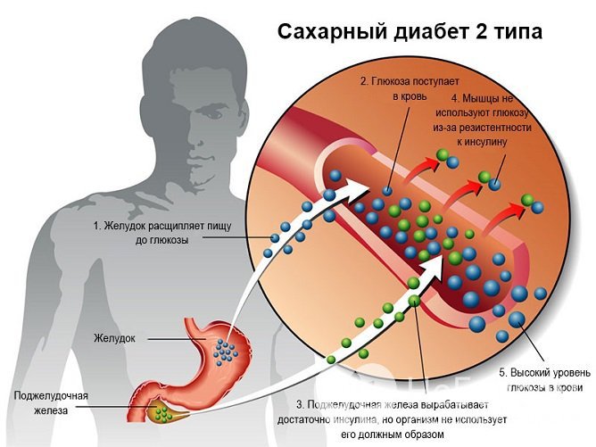 Сахарный диабет 2 типа может приводить к развитию сердечной недостаточности