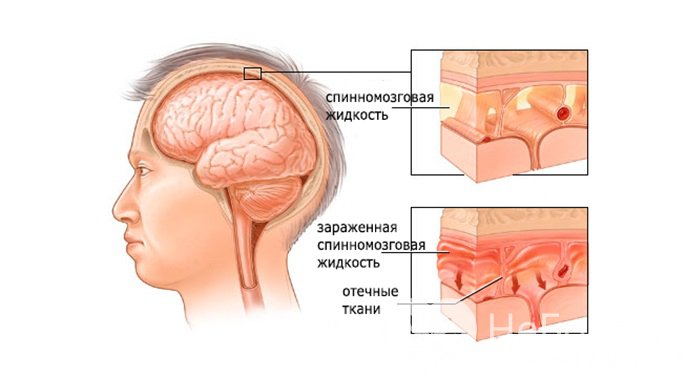 Признаки серозного менингита