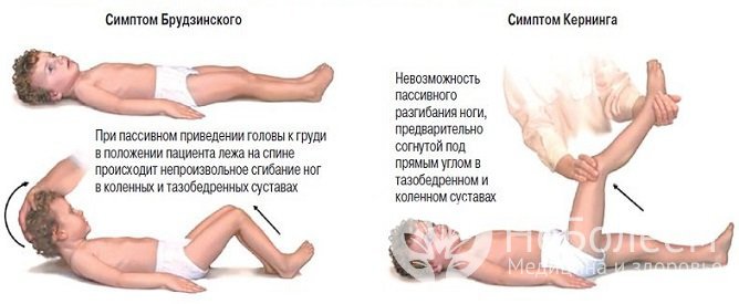 Характерные симптомы серозного менингита у детей