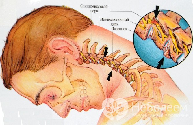 Шейный остеохондроз: симптомы и лечение