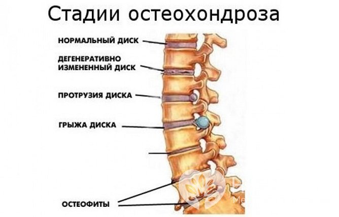 Стадии остеохондроза