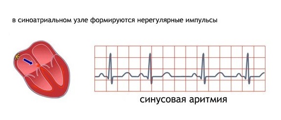 При синусовой аритмии в синоатриальном узле формируются нерегулярные импульсы