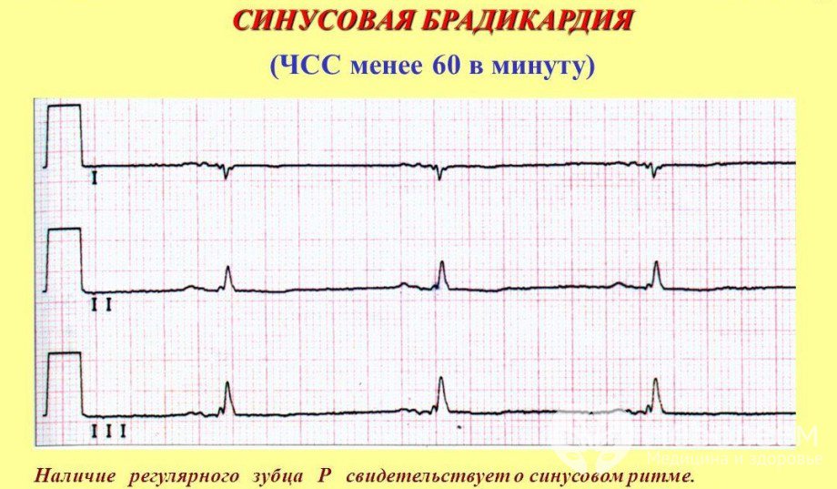 Признаки синусовой брадикардии