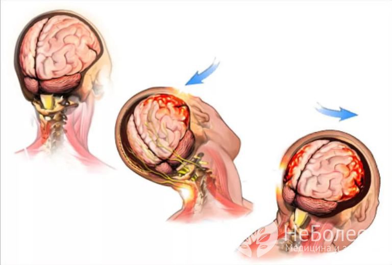 Признаки сотрясения головного мозга