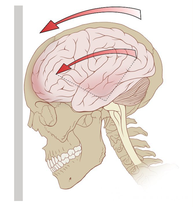Чаще всего сотрясение головного мозга является следствием травм и ударов головой