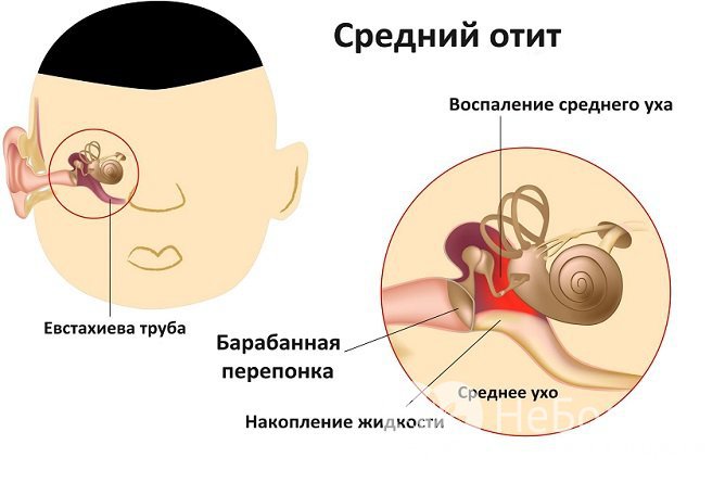 Средний отит: симптомы и лечение