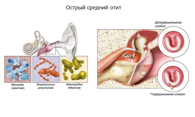 Стадии среднего отита