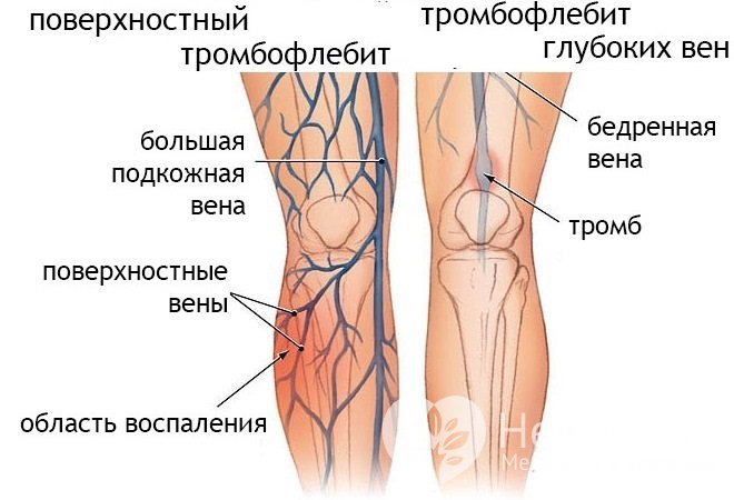 Тромбофлебит вен нижних конечностей бывает поверхностный и глубокий