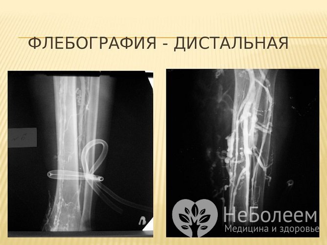 Дистальная восходящая флебография – наиболее точный метод диагностики тромбофлебита