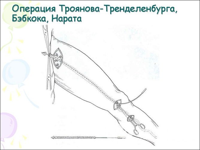 Гнойный тромбофлебит вен нижних конечностей – показание к хирургическому вмешательству