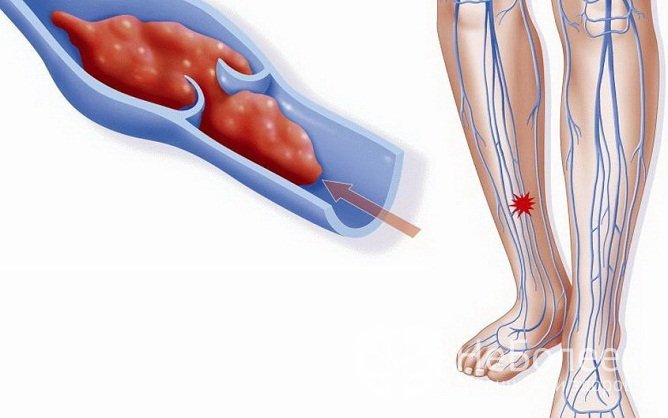 К развитию тромбофлебита может привести повышенная свертываемость крови