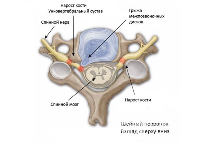 Признаки унковертебрального артроза