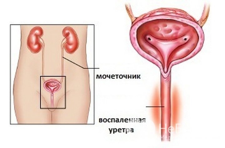 Признаки уретрита у женщин