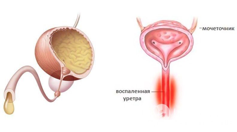 Признаки уретрита