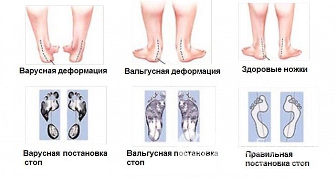 Как понять, что у ребенка вальгусная деформация стопы