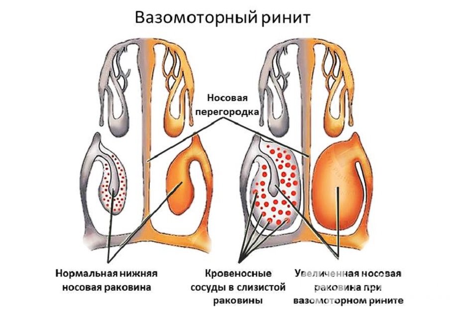 Симптомы вазомоторного ринита