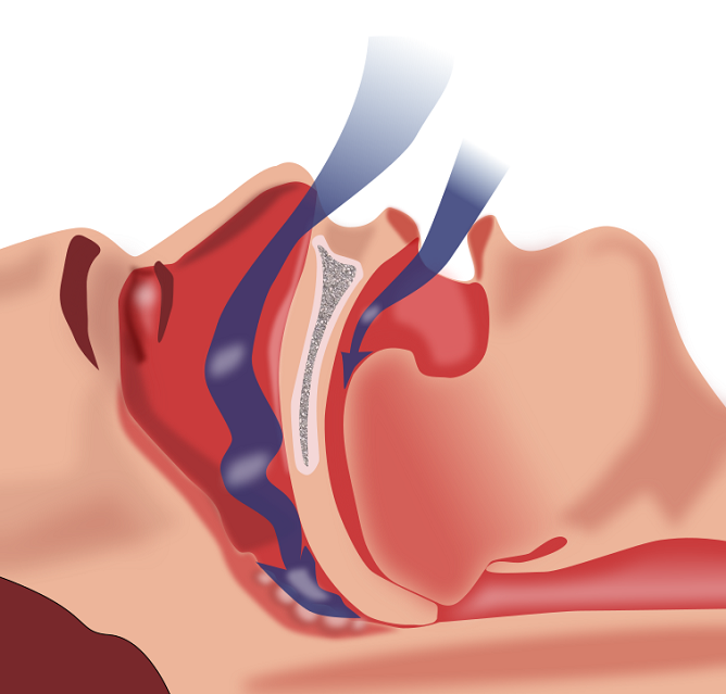 Затрудненное дыхание при вазомоторном рините может становится причиной апноэ сна