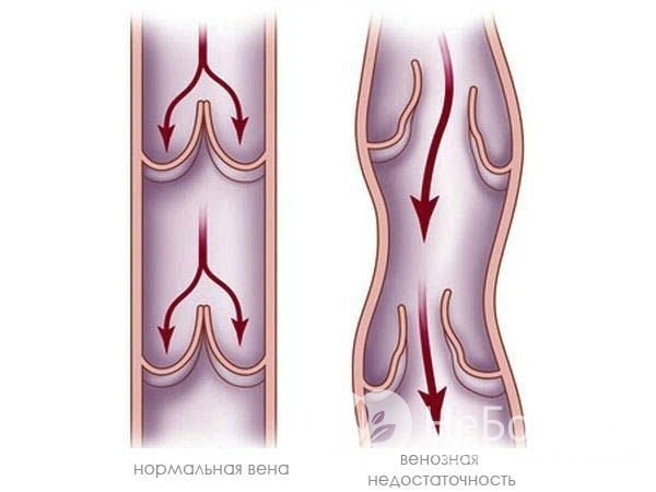 При венозной недостаточности сосуды расширяются, и створки клапанов перестают смыкаться между собой