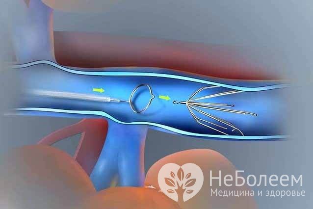 Если венозная недостаточность угрожает образованием флотирующего тромба, проводят операцию по установке кава-фильтра