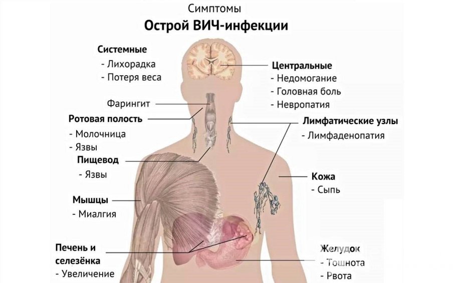 Симптомы острой ВИЧ-инфекции