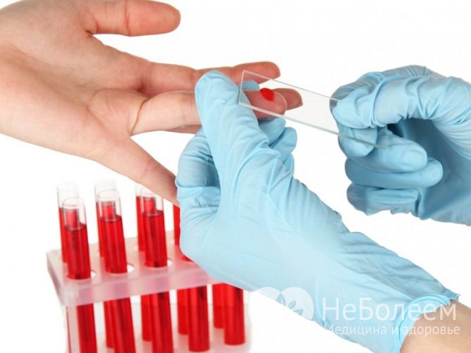 Для диагностики вируса Эпштейна-Барр необходимо выявить антитела IgM, IgG, IgA в анализе крови