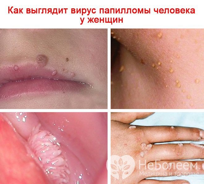 Если вирус папилломы человека у женщины поражает кожные покровы, появляются бородавки, кондиломы, папилломы