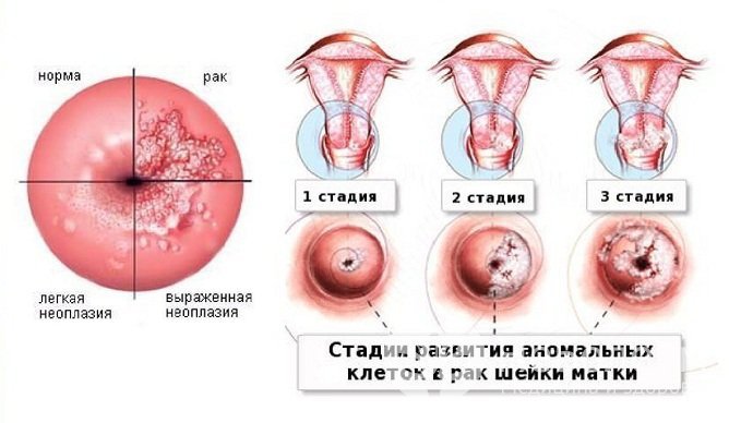 Стадии неопластического процесса шейка матки при ВПЧ