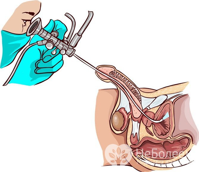 У мужчин при подозрении на ВПЧ проводится уретроскопия