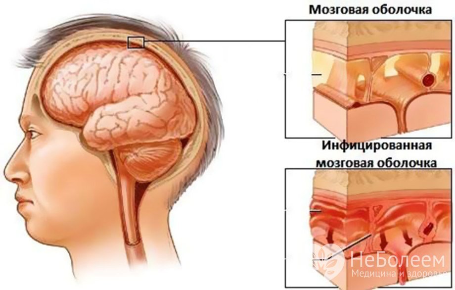 Признаки вирусного менингита