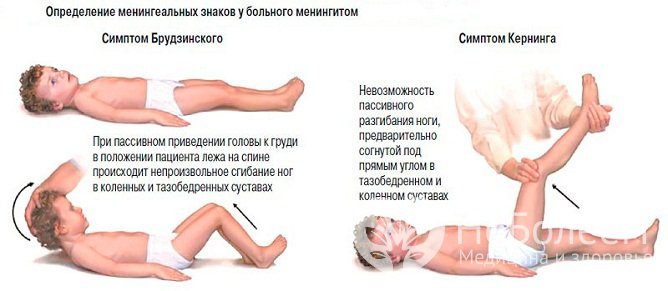 Специфические симптомы менингита, в том числе вирусного