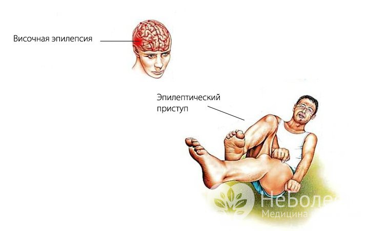 Признаки височной эпилепсии 