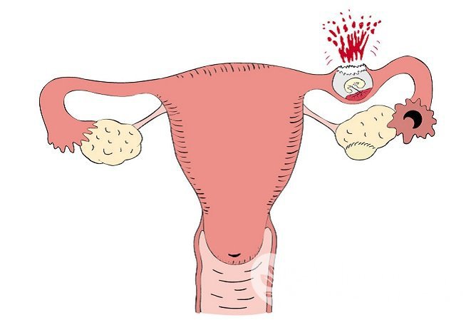 Разрыв маточной трубы грозит массивным внутренним кровотечением, что угрожает жизни женщины