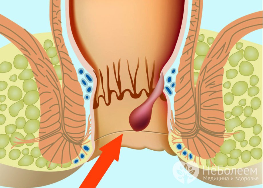 Признаки внутреннего геморроя