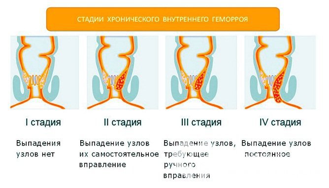 Стадии внутреннего геморроя