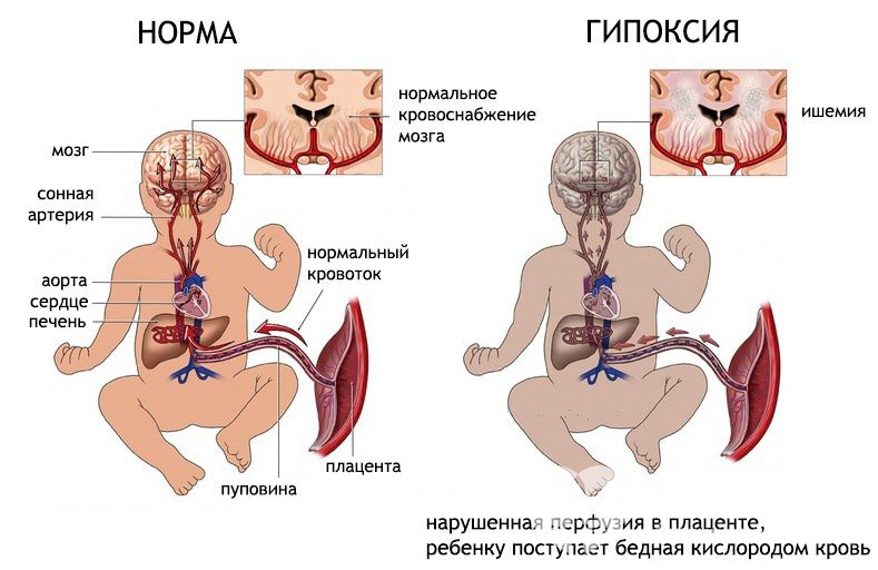 Признаки внутриутробной гипоксии