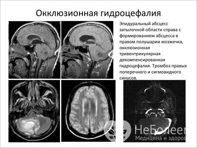 Окклюзионная гидроцефалия на рентгеновском снимке