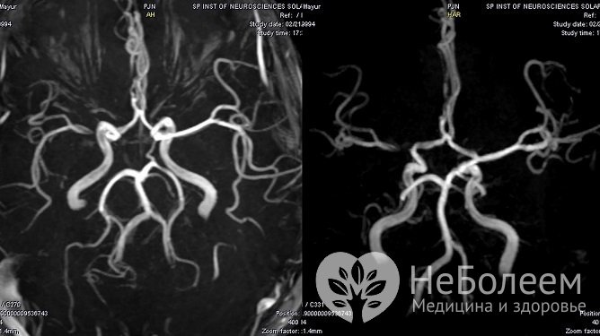 Для диагностики водянки головного мозга может проводиться ангиография мозговых артерий