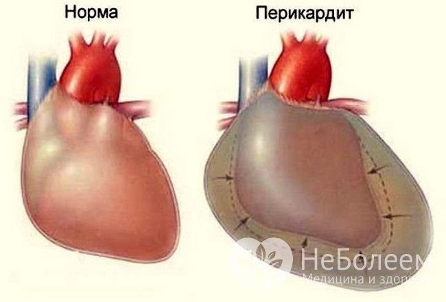 Перикардит или водянка сердца