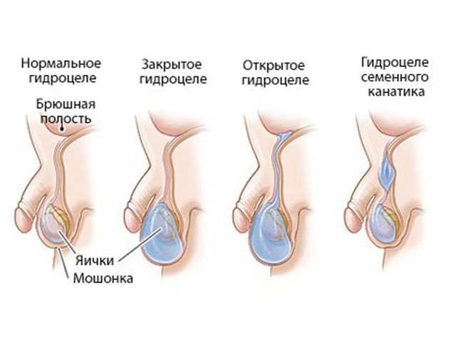 Виды водянки яичка или гидроцеле