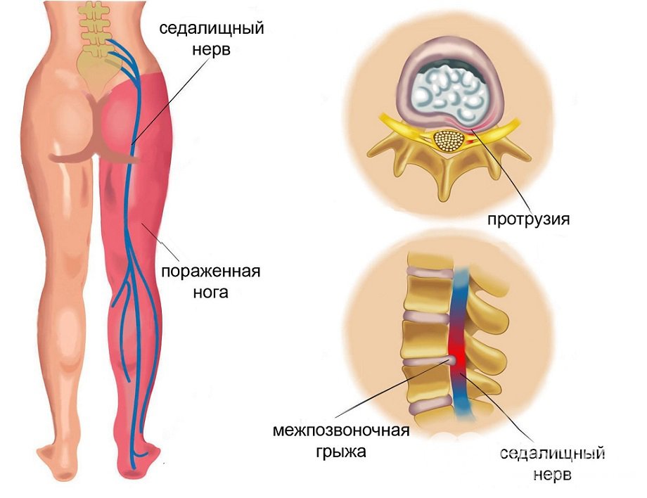 Признаки воспаления седалищного нерва