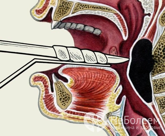 Хирургическое вскрытие абсцесса проводится при неэффективности медикаментозного лечения