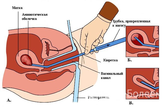 Вакуумная аспирация применяется для удаления плодного яйца на ранних сроках беременности