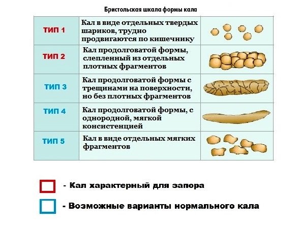 Какой кал считается запором?