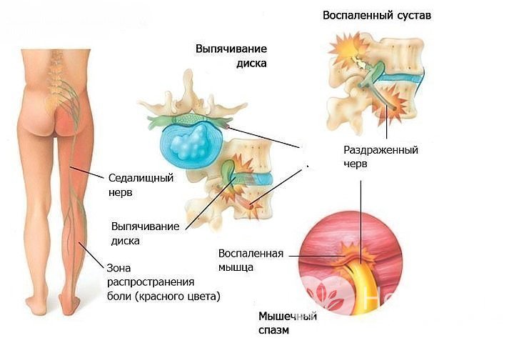 Признаки защемления седалищного нерва