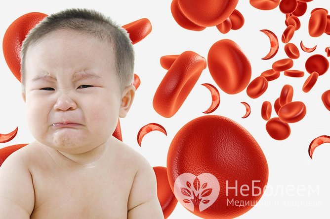 Железодефицитная анемия встречается у 40% детей первых лет жизни
