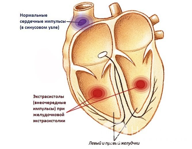 Что такое желудочковая экстрасистолия?