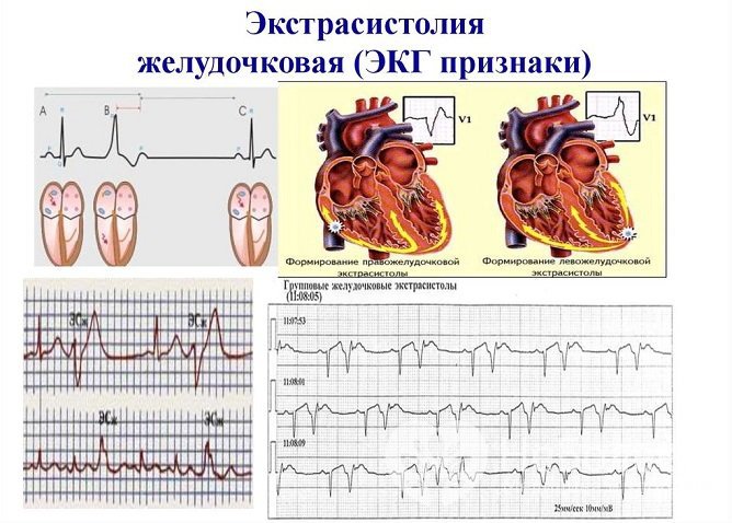 Диагностика желудочковой экстрасистолии