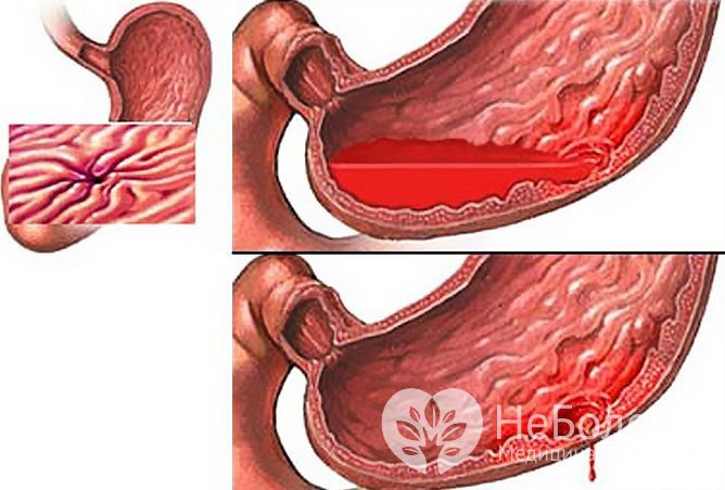 Желудочное кровотечение: причины и лечение