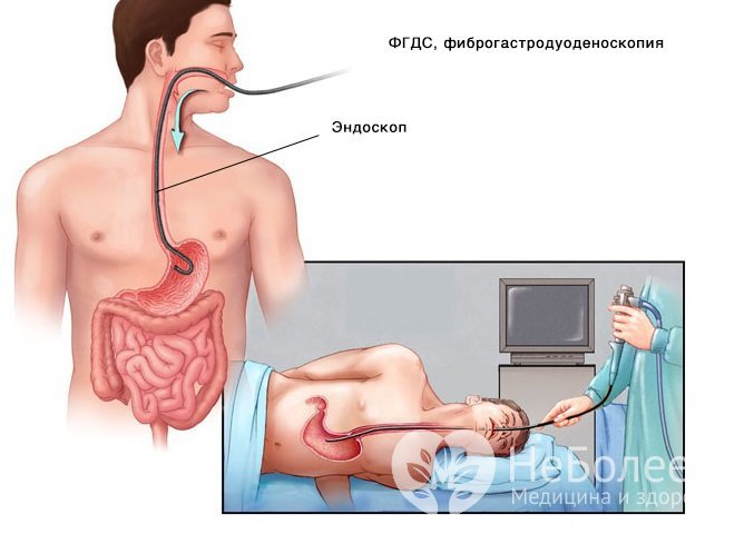 Фиброгастродуоденоскопи - основной метод диагностики желудочного кровотечения