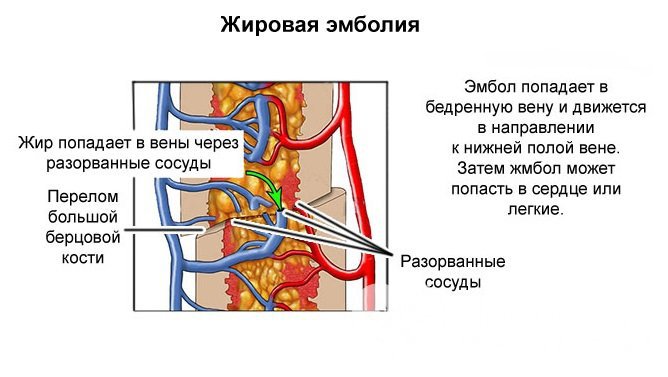 Причины развития жировой эмболии